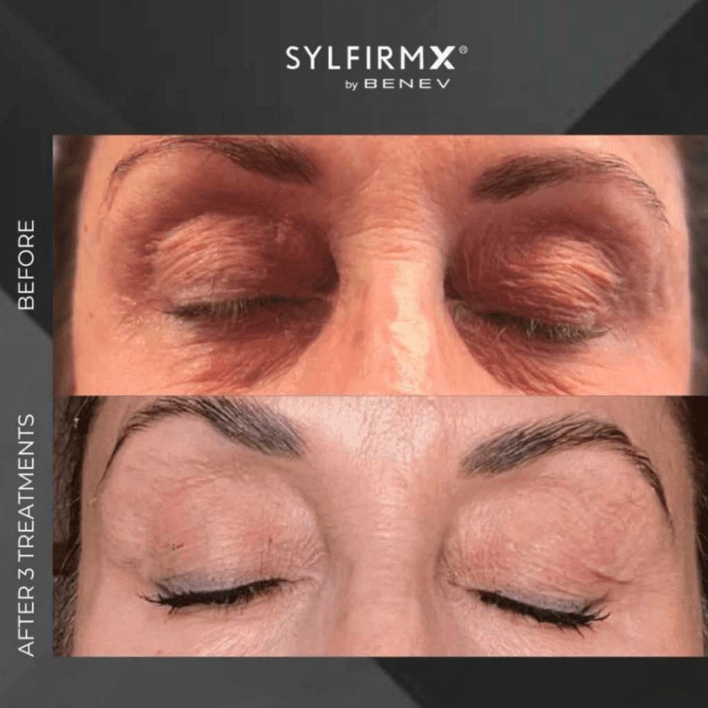 Sylfirm eye treatment