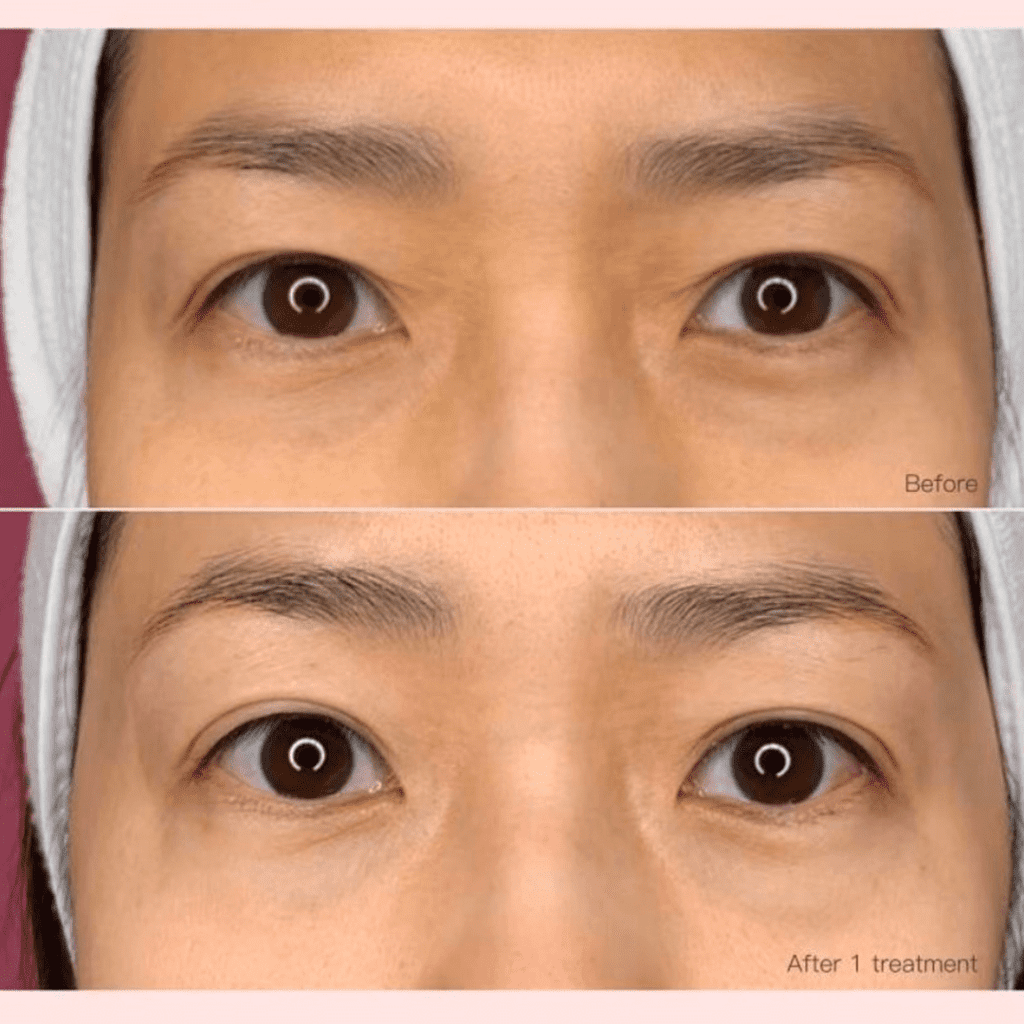 Sylfirm eye treatment